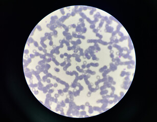 Malaria pigment blood parasite infected rbc.