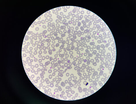 Malaria pigment blood parasite infected rbc.