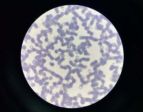 Malaria pigment blood parasite infected rbc.