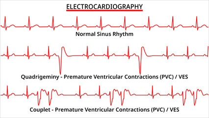 Set of ECG Common Abnormalities - Couplet vs Quadrigeminy Premature Ventricular Contractions (PVC) - Ventricle Extra Systole (VES) -  Electrocardiography Vector Medical Illustration - obrazy, fototapety, plakaty
