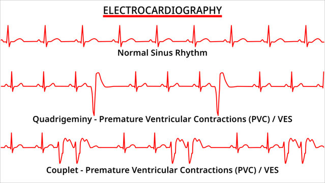 Set of ECG Common Abnormalities - Couplet vs Quadrigeminy Premature Ventricular Contractions (PVC) - Ventricle Extra Systole (VES) -  Electrocardiography Vector Medical Illustration