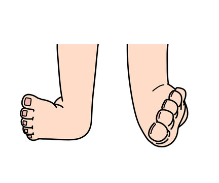 内反足・外反足