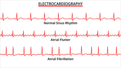Set of ECG Common Abnormalities - Atrial Flutter vs Atrial Fibrillation - Normal Sinus Rhythm - Electrocardiography Vector Medical Illustration - obrazy, fototapety, plakaty