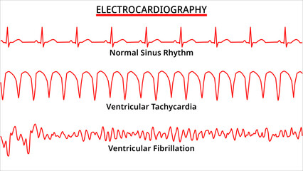 Set of ECG Common Abnormalities - Ventricular Tachycardia vs Ventricular Fibrillation - Normal Sinus Rhythm - Electrocardiography Vector Medical Illustration