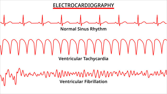 Set of ECG Common Abnormalities - Ventricular Tachycardia vs Ventricular Fibrillation - Normal Sinus Rhythm - Electrocardiography Vector Medical Illustration
