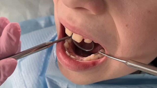 Dentist doctor examines oral cavity of small patient. Dentist uses mirror for mouth and child milk teeth closeup