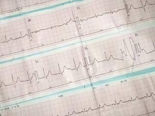 hyperacute t wave on anterior wall that usually indicates ischemia or hyperkalemia or potassium excess
