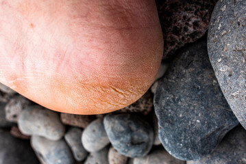 2022 08 24 Madeira cracked foot skin