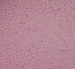 Chronic myeloid leukemia (CML) in accelerated phase also known as Chronic myelogenous leukemia. Thrombocytosis. Red blood cell. Blood smear.