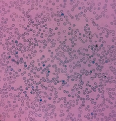 Close view of Reticulocyte count under microscope, 40x. methylene blue staining.