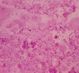 Tumor of temporal region(FNA cytology). Benign adnexal tumor. Smear show cellular material of regular looking epithelial cells and stromal cells. no malignancy seen.