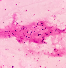 Tumor of temporal region(FNA cytology). Benign adnexal tumor. Smear show cellular material of...