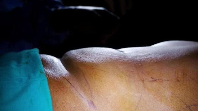 4K close-up shot at doctor hand and tummy. Doctor grabbing patient's abdomen with excess fat before real tummy tuck stock video.