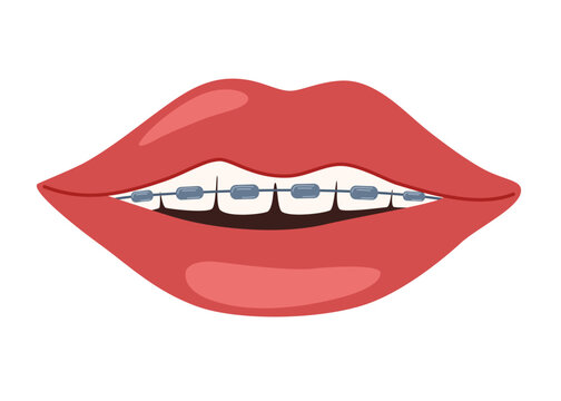 Mouth with braces on teeth. Installing braces. Correction of byte. Dentistry. Orthodontics. Installing braces. Metal braces. Straight teeth. Vector illustration 