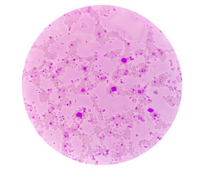 Chronic myeloid leukemia (CML) in accelerated phase with thrombocytosis. Chronic myelogenous...