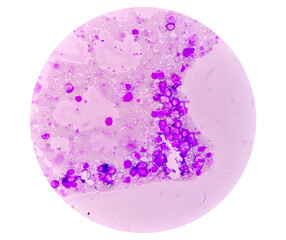 Chronic myeloid leukemia (CML) in accelerated phase with thrombocytosis. Chronic myelogenous leukemia.