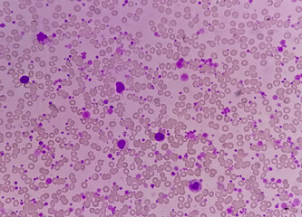 Chronic myeloid leukemia (CML) in accelerated phase with thrombocytosis. Chronic myelogenous...