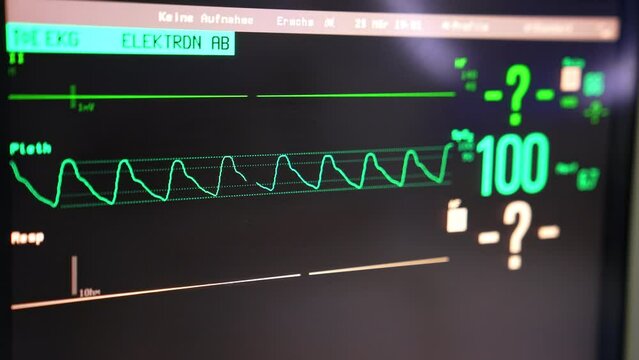 Running curve of patient&rsquo;s heart rate during the surgery. Equipment working in operational theatre. Close up.