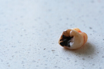 close up one removed human decayed wisdom tooth. Black dental caries