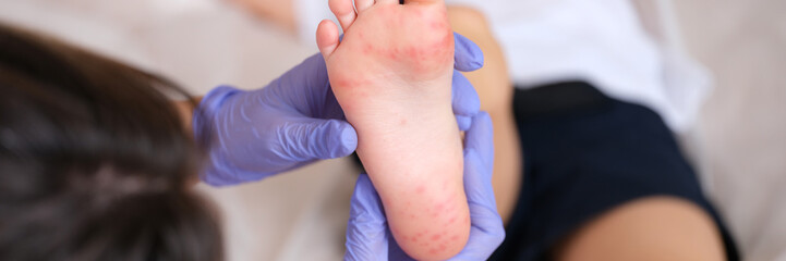 Doctor examines red rashes on feet of child closeup