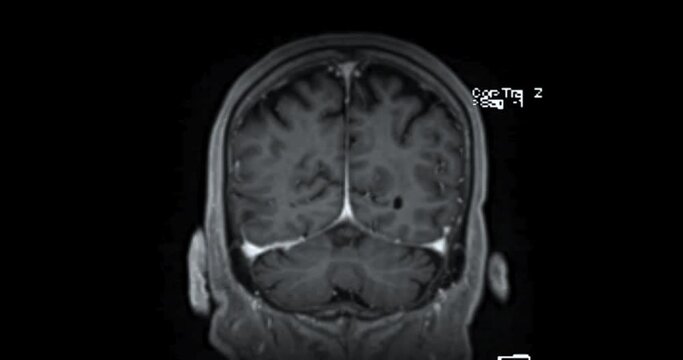MRI Brain  can help doctors look for conditions such as bleeding, swelling, tumors, infections, inflammation, damage from an injury or a stroke diseases.