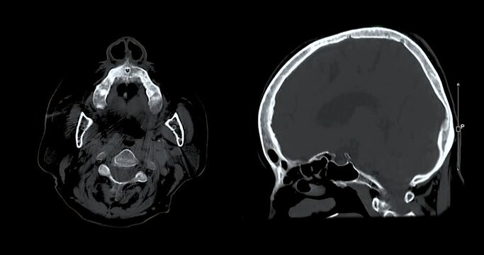 CT scan of the brain  for diagnosis brain tumor,stroke diseases and vascular diseases.