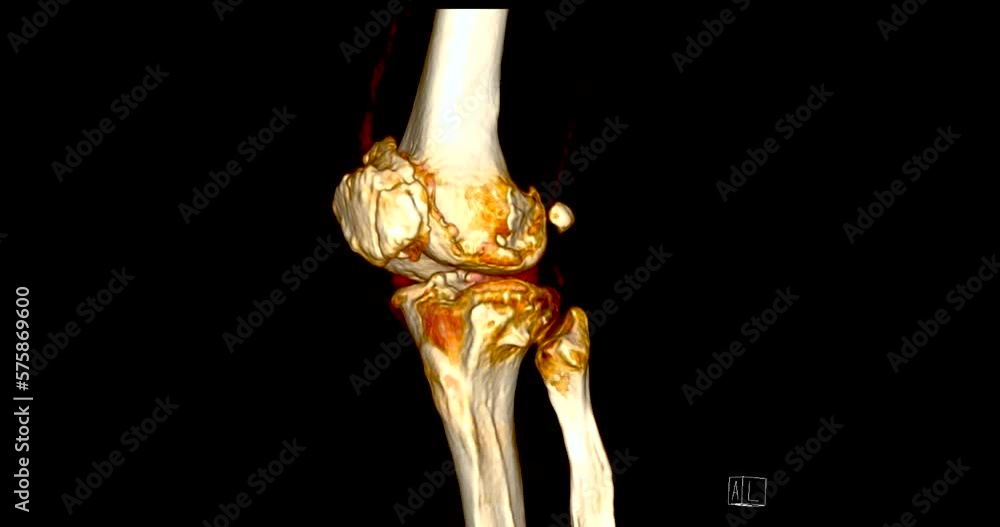 Poster ct scan of knee joint 3d rendering showing fracture of lateral condyle of femur bone.