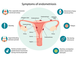 Endometriosis Symptoms infographic. Detailed vector Infographic. Women Health