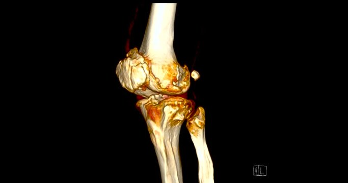 CT Scan of  Knee joint 3D rendering showing fracture of lateral condyle of femur bone.