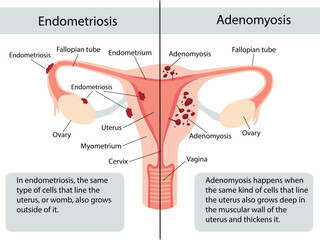 Anatomical illustration of the female reproductive system with the symptoms of adenomyosis and the symptoms of endometrioses, with annotations.