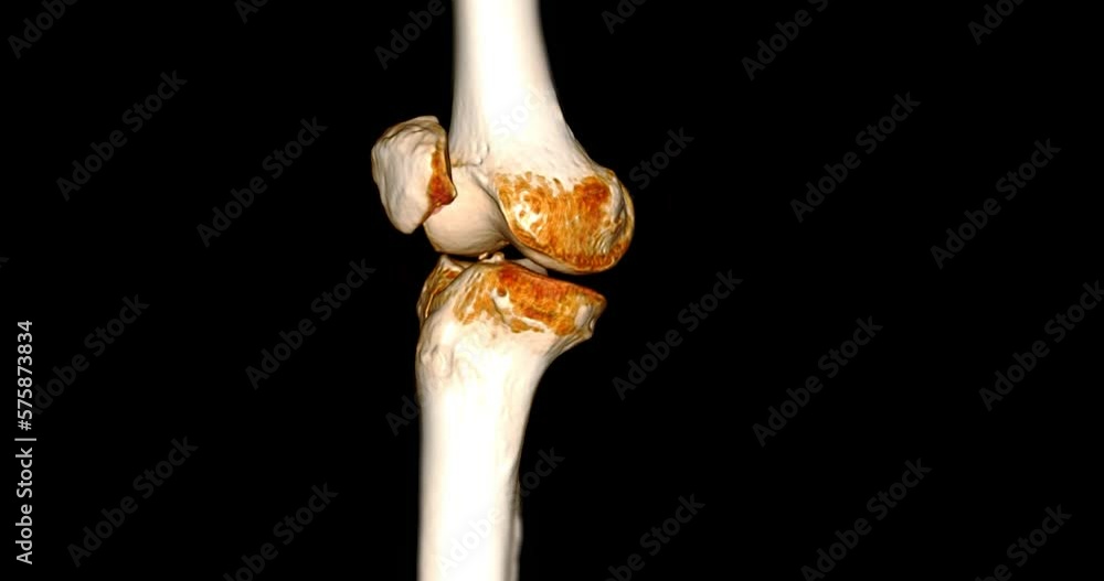 Poster ct scan of knee joint 3d rendering showing fracture of lateral condyle of femur bone.