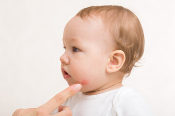 Young adult mother finger pointing to red rash on infant cheek. Baby boy isolated on light gray...