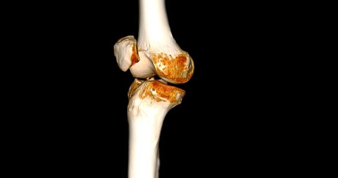 CT Scan of  Knee joint 3D rendering showing fracture of lateral condyle of femur bone.