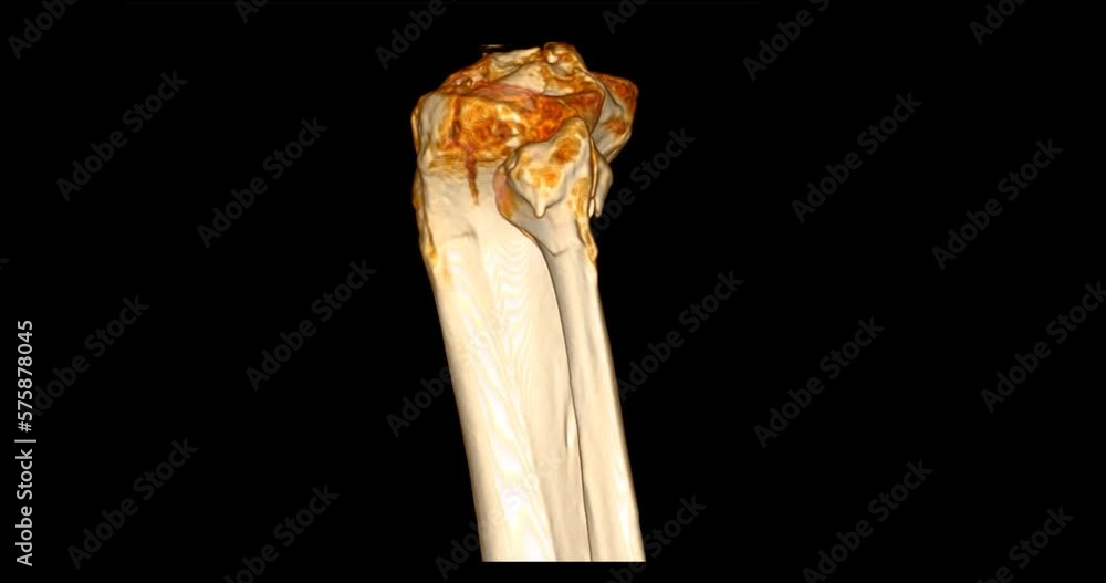Poster ct scan of knee joint 3d rendering showing fracture tibia and fibula bone.