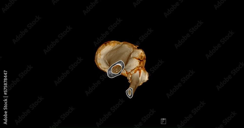 Poster ct scan of knee joint 3d rendering showing fracture tibia and fibula bone.
