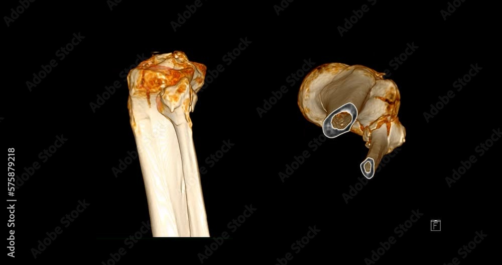 Poster ct scan of knee joint 3d rendering showing fracture tibia and fibula bone.