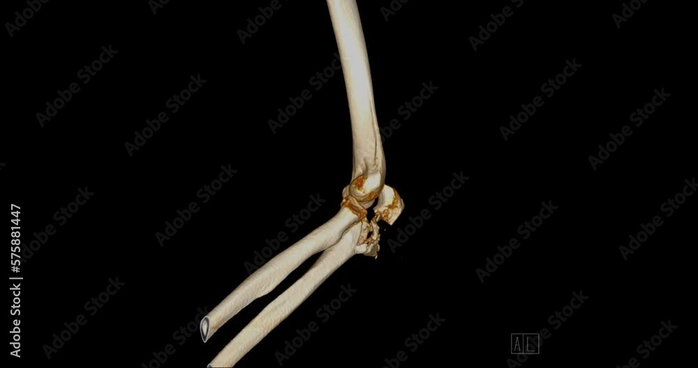 Poster ct elbow 3d rendering image turnaround on the screen showing fracture of elbow