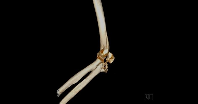 CT Elbow 3D rendering image turnaround on the screen showing fracture of elbow