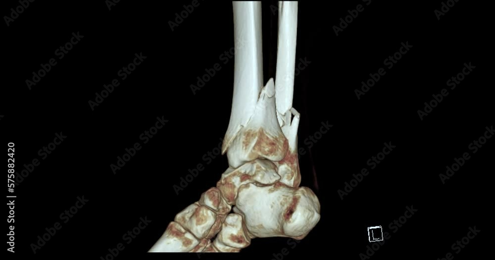 Poster ct scan of ankle joint 3d rendering showing tibia and fibula bone fracture.