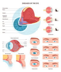 Human eye diseases set. Human vision organ, eyesight and eyelid problem.