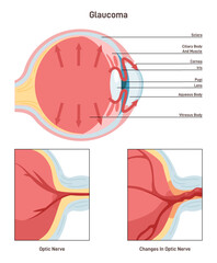 Glaucoma. Damage to the optic nerve and can lead to vision loss.