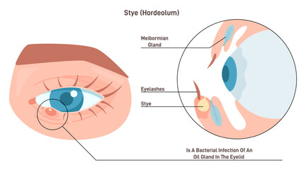 Eye stye or hordeolum. Red, painful lump near the edge of the eyelid.