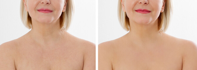 Closeup banner before after neckline middle age woman skin. Before-after skincare aged spots....