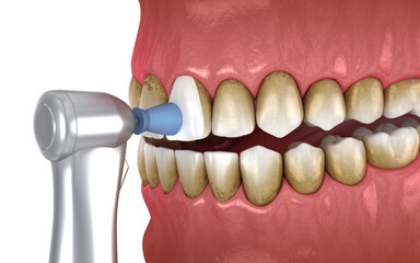 Teeth polishing procedure with professional brush and gel. Medically accurate 3D illustration