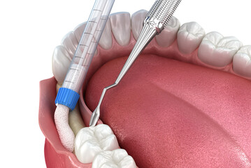 Bone grafting augmentation for tooth implantation. Medically accurate 3D illustration. - 575908207