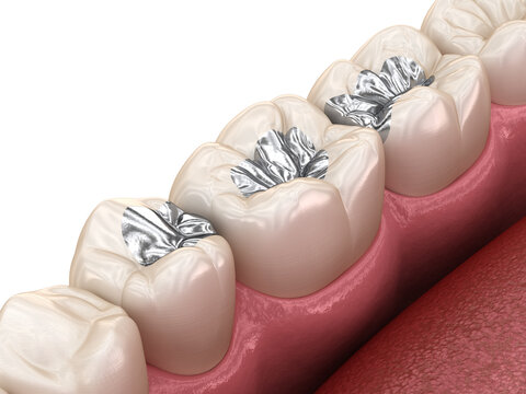 Amalgam restoration. Medically accurate 3D animation of dental concept