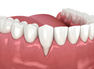 Gum Recession. 3D illustration of Dental problem