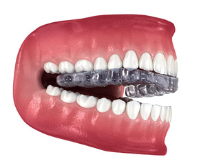 Bite Splint - bruxism protection. Medically accurate dental 3D illustration - 575908606