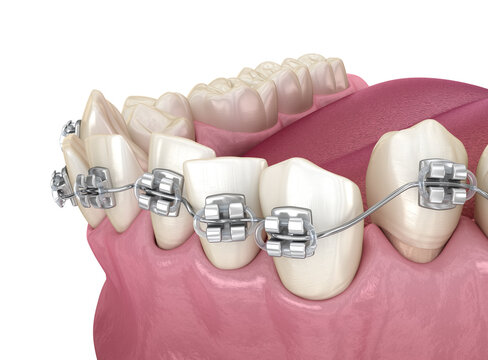 Abnormal teeth position and correction with metal braces tretament. Medically accurate dental 3D illustration