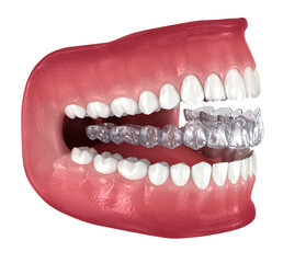 Invisalign braces or invisible retainer. Medically accurate dental 3D illustration